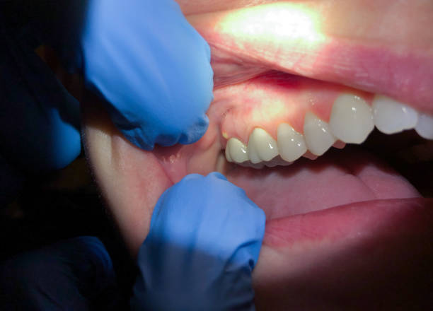 Best Emergency Wisdom Teeth Removal in Meadow Oaks, FL